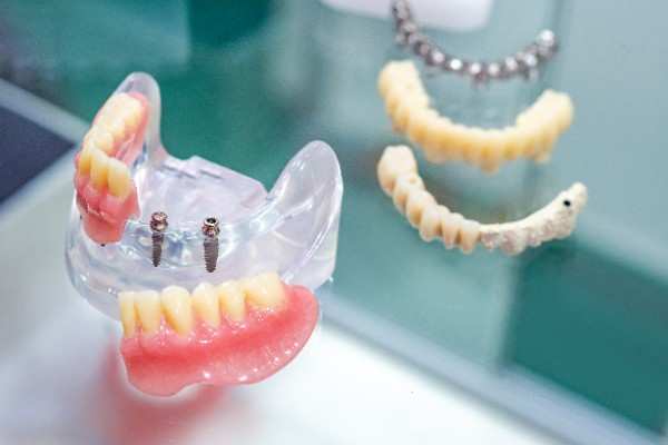 dental implants Newquay 