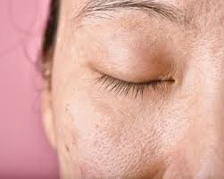 laser for dark spots
