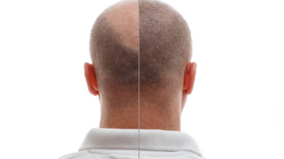 Hair Transplant in Riyadh