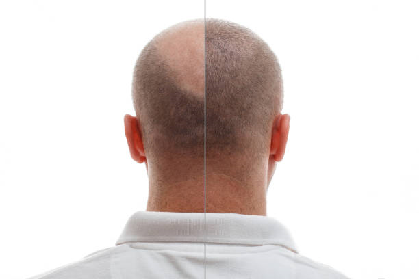 Hair Transplant in Riyadh