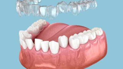 Smilo Dental Implants