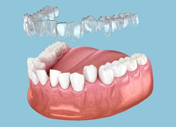 Smilo Dental Implants