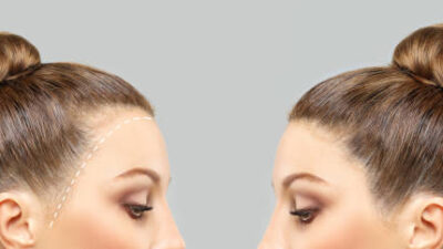 زراعة الشعر في الرياض