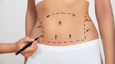 Liposuction in Riyadh