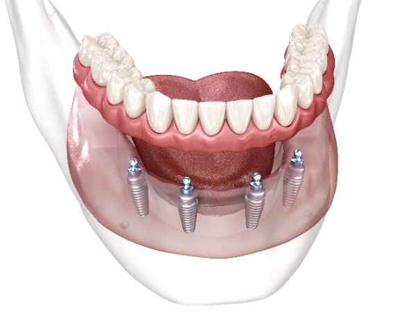 dental implants 