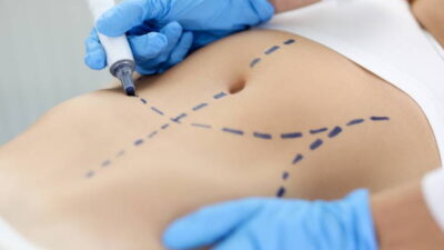 Liposuction in Riyadh