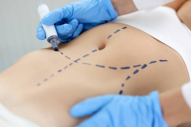 Liposuction in Riyadh