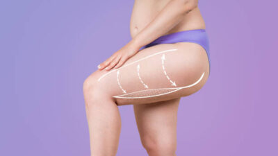 Liposuction in Riyadh