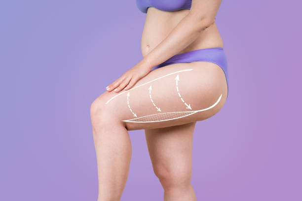 Liposuction in Riyadh