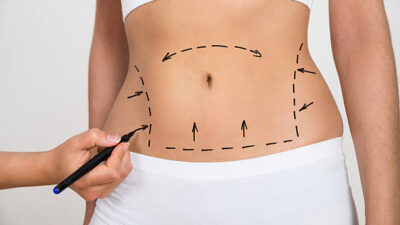 Liposuction in Riyadh